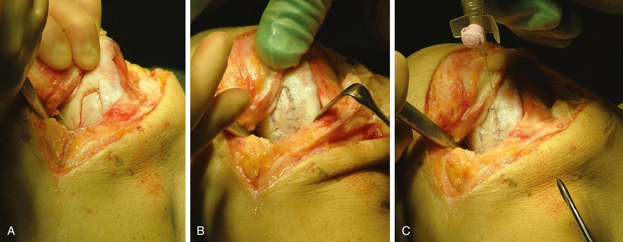 FIG 29.10, (A) The periosteal flap is first anchored with a suture in each corner. (B) The flap is then sutured to the cartilage rim. (C) The integrity of the chamber under the flap is tested with an injection of saline.