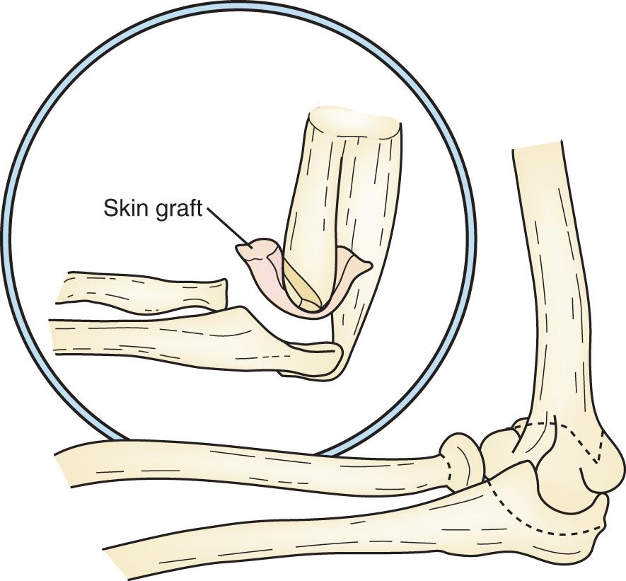 FIG 114.1, The early functional or anatomic arthroplasty resects and fashions the distal end of the humerus to serve as a fulcrum against which the proximal end of the ulna pivots. Skin and other substances may cover the humerus, hence the term interposition arthroplasty .