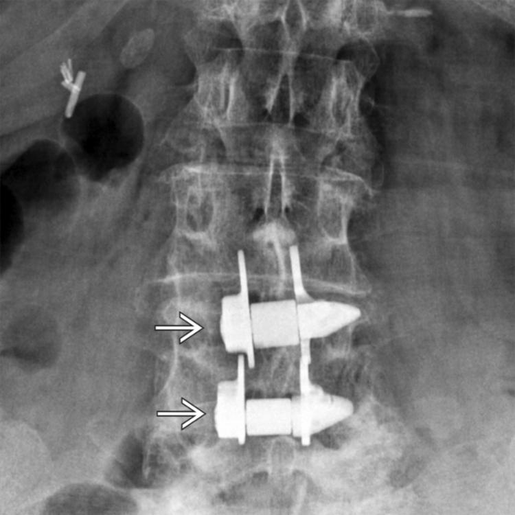X-Stop implants at L4-L5 & L5-S1 are titanium alloy devices placed between spinous processes to reduce canal & foraminal narrowing that occurs in extension, thus reducing the symptoms of neurogenic intermittent claudication.