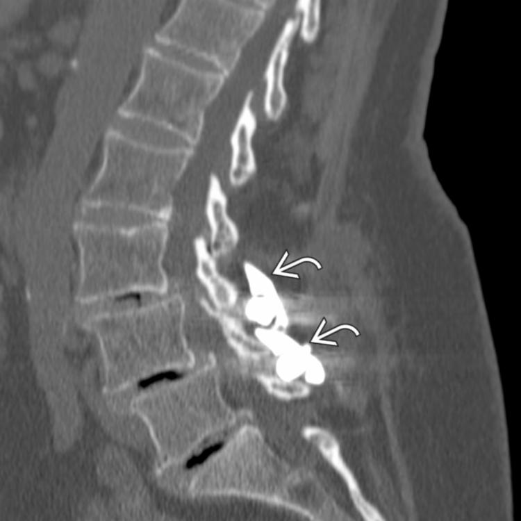 Sagittal bone CT shows an interspinous spacing device (ISD) , which may increase the foraminal area & height as well as spinal canal diameter in extension. ISDs may improve recurrent facet joint pain in clinical short- and midterm settings but do not exceed outcome of denervated patients.