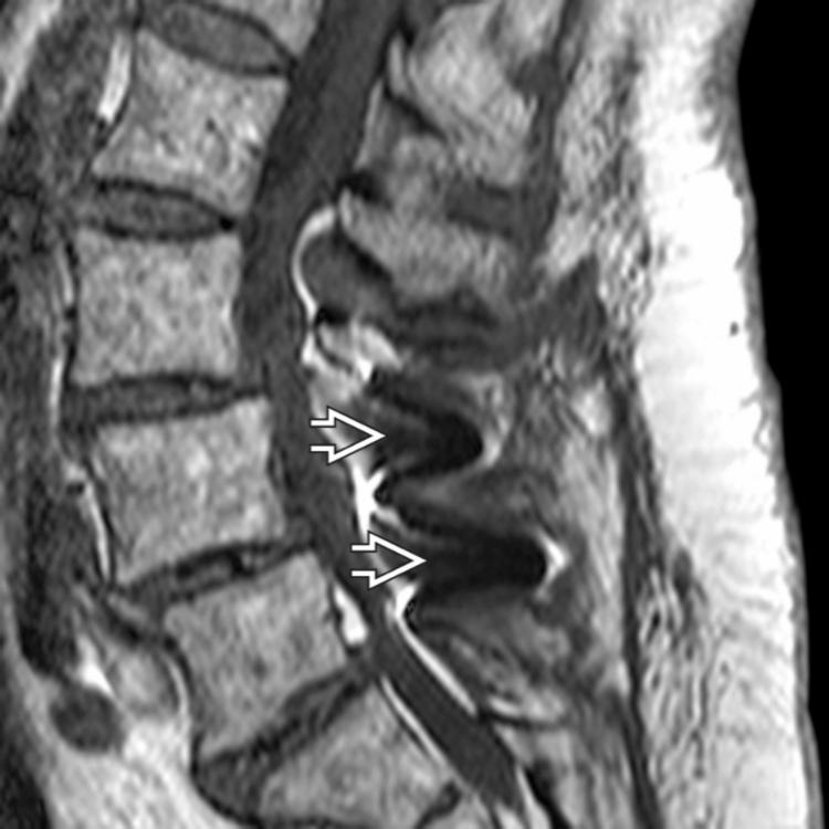 Sagittal T1WI MR shows the susceptibility artifact from the ISDs . X-Stop is the most commonly used ISD in patients with neurogenic intermittent claudication due to lumbar stenosis.