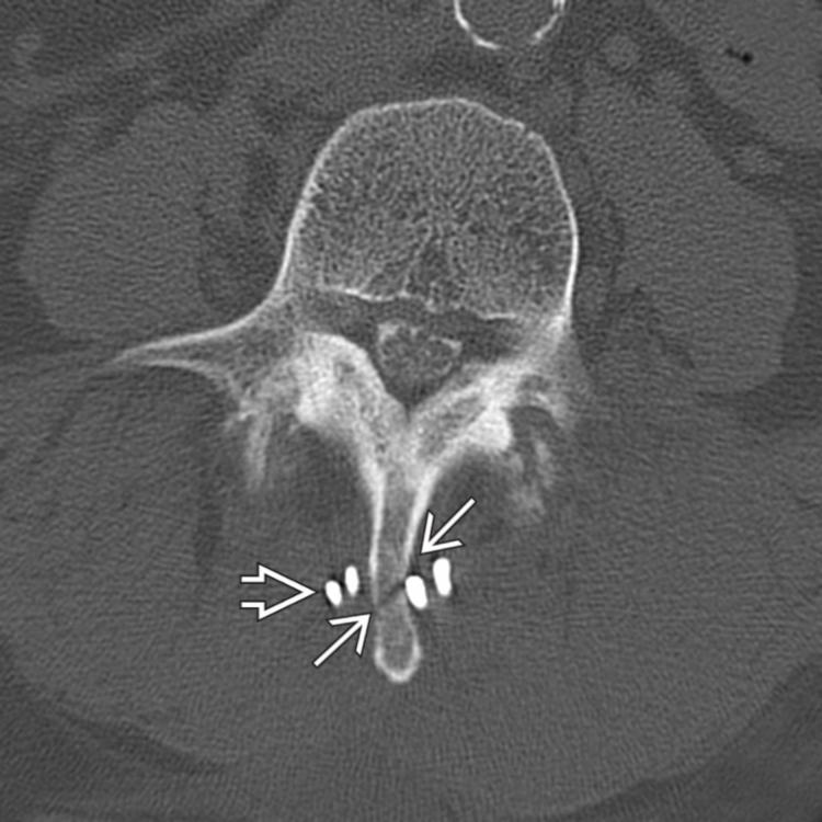 Axial CT myelographic image of spinous process fractures at 2 levels following placement of X-Stop devices for canal stenosis shows fractures through the L4 spinous processes . Note the overlap of the wings of the adjacent level devices .