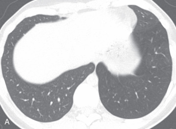 Figure 19.2, (A) Inspiratory image from high-resolution chest CT scan demonstrates relative hyperlucency and paucity of vessels of the left lower lobe compared to other portions of the lungs. (B) Expiratory image demonstrates marked air trapping throughout the left lower lobe.