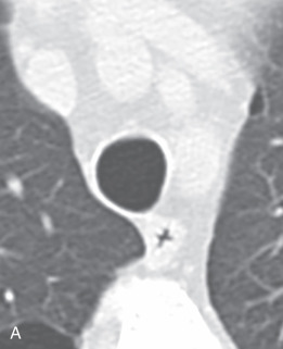 Figure 19.3, Inspiratory (A) and expiratory (B) images from chest CT scans demonstrate the typical appearance of the trachea during different phases of the respiratory cycle. During inspiration, the trachea is typically convex throughout its margins and has an oval shape. During expiration, the posterior aspect of the trachea composed primarily of the trachealis muscle and connective tissue bows anteriorly.