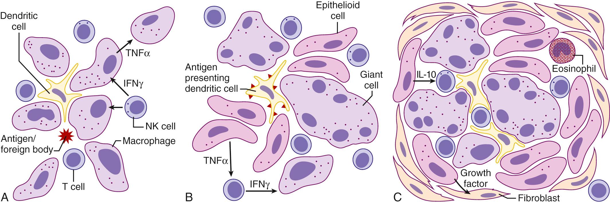 FIGURE 11-1, Granuloma formation and maturation. A, Early accumulation of macrophages around antigen or foreign body. Release of proinflammatory cytokines tumor necrosis factor alpha (TNFα) and interferon-gamma (IFNγ), and chemokines such as macrophage inflammatory protein 1α results in activation of macrophages and recruitment of other immune cells. B, Antigen presentation by dendritic cells and macrophages to incoming T cells results in further activation, with development of epithelioid and giant cells. It is at this stage that fibroblasts become activated, resulting in focal areas of fibrosis. C, As the granuloma matures, the structure becomes more compact, with giant cells and T cells at the core. The initial helper T cell 1 (T H 1) response leads to the release of T H 2 cytokines as well, with interleukin (IL)-5 recruitment of eosinophils. NK, Natural killer.