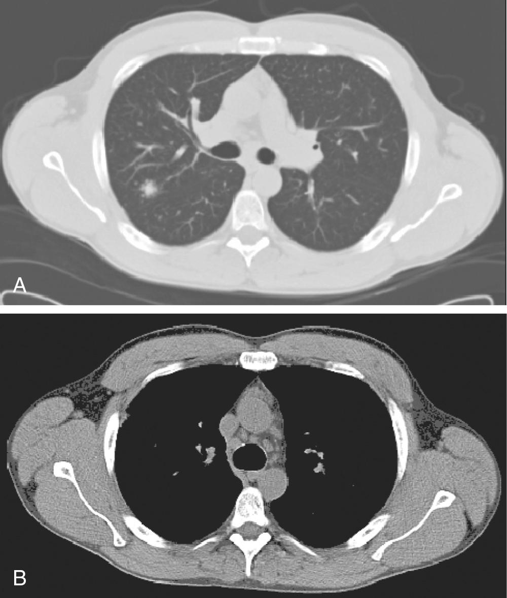 FIGURE 11-2, Computed tomography of the chest from a patient found to have noncaseating, non-necrotizing granulomata in the mediastinal lymph nodes on cervical mediastinoscopy. These findings are consistent with the diagnosis of sarcoidosis. A, Lung window. B, Mediastinal window.