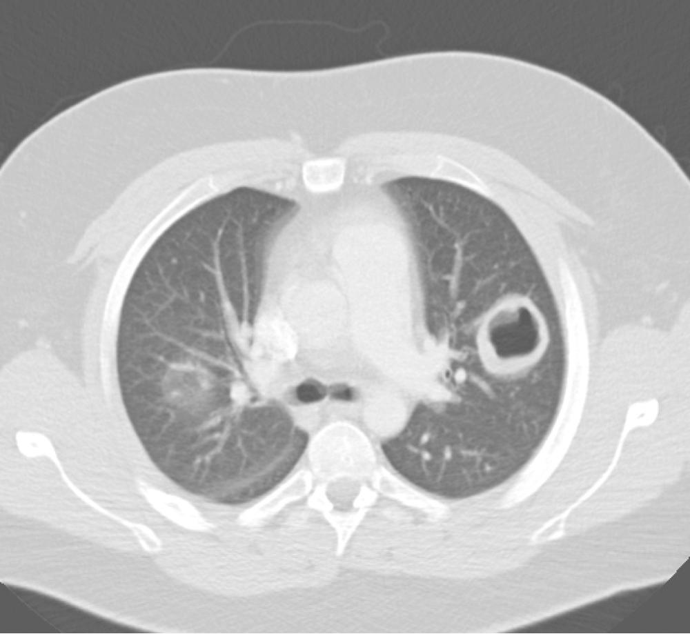 FIGURE 11-3, Computed tomography of the chest from a young man with Wegener granulomatosis. Central necrosis in a granulomatous lesion has the appearance of a cavitary lesion. Many other such lesions were present throughout the lung parenchyma.