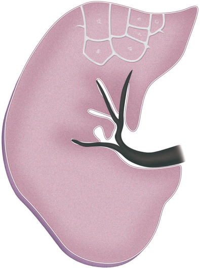 Fig. 5.1, Schematic drawing of septal pattern. Drawing of the right lung shows thin lines separated by 1–2 cm that correspond to thickened interlobular septa.