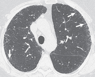 Fig. 5.12, Irregular septal thickening in idiopathic pulmonary fibrosis. High-resolution CT scan shows a few bilateral irregularly thickened septa (arrows). Note also the presence of smaller intralobular lines resulting in a fine reticular pattern, architectural distortion, and subpleural distribution of findings characteristic of idiopathic pulmonary fibrosis.