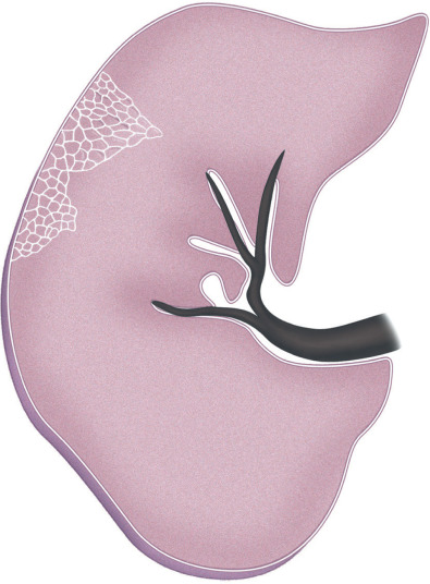 Fig. 5.13, Schematic drawing of reticular pattern. Drawing of the right lung illustrates reticular pattern. A reticular pattern on high-resolution CT typically results from intralobular lines (i.e., fine linear opacities visible within a secondary pulmonary lobule as a result of thickening of the intralobular interstitial tissue).