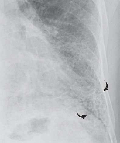 Fig. 5.14, Reticular pattern on chest radiography in idiopathic pulmonary fibrosis. Magnified view of the left lower lung zone shows extensive reticular pattern (arrows). The reticular pattern in this patient was caused by summation of irregular linear opacities and honeycombing.