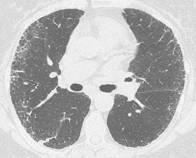 Fig. 5.15, Reticular pattern on high-resolution CT in idiopathic pulmonary fibrosis. High-resolution CT scan at the level of bronchus intermedius shows bilateral subpleural irregular intralobular linear opacities and irregular septal thickening resulting in a fine reticular pattern.