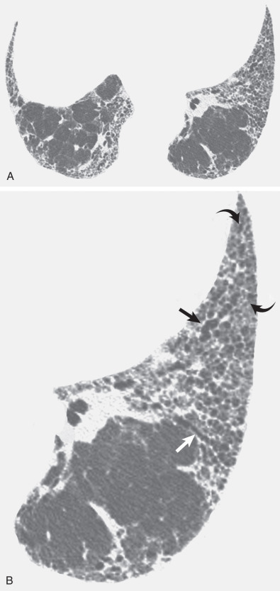 Fig. 5.16, Severe reticular pattern with traction bronchiectasis and bronchiolectasis in idiopathic pulmonary fibrosis. (A) High-resolution CT scan at the level of the lung bases shows reticular pattern in the peripheral regions of the lower lobes and diffusely in the middle lobe and lingula. (B) Magnified view of the left lower lung zone shows reticular pattern. Also noted is dilation and beading of bronchi (traction bronchiectasis) (straight arrows). Dilated airways within approximately 0.5–1 cm from the pleura represent ectatic bronchioles (traction bronchiolectasis) (curved arrows).