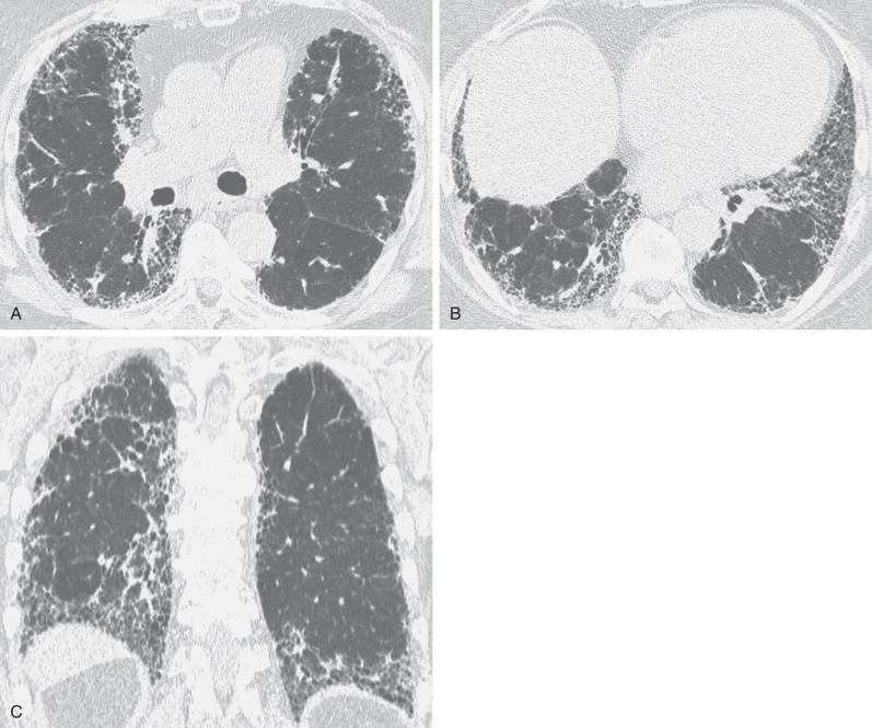 Fig. 5.17, Idiopathic pulmonary fibrosis. (A) High-resolution CT scan at the level of the bronchus intermedius shows bilateral reticular pattern involving almost exclusively the peripheral lung regions. (B) High-resolution CT scan at the level of the lung bases shows more extensive reticulation and subpleural honeycombing. (C) Coronal reformation shows reticulation in all lobes, but it is most severe in the subpleural lung regions and lung bases.