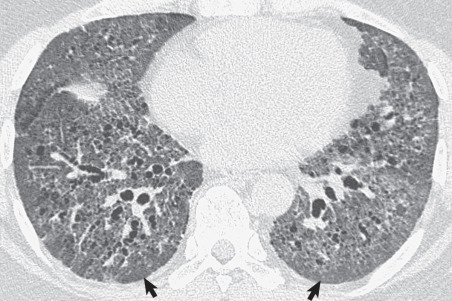 Fig. 5.19, Nonspecific interstitial pneumonia: relative subpleural sparing. High-resolution CT scan shows extensive bilateral ground-glass opacities, traction bronchiectasis, and reticulation. The reticulation is less severe in the lung immediately adjacent to the pleura (arrows) than in the lung 1 cm away from the pleura (relative subpleural sparing), a characteristic finding seen in approximately 50% of patients with nonspecific interstitial pneumonia.