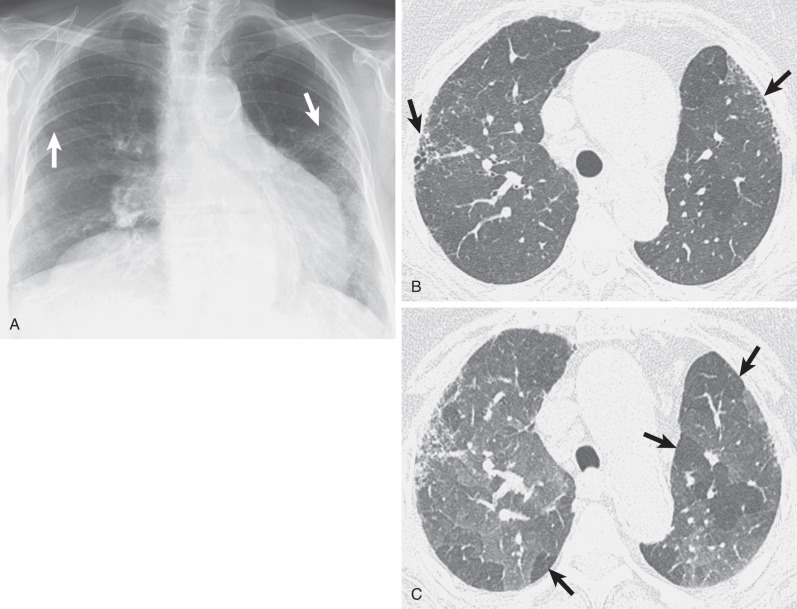 Fig. 5.20, Chronic hypersensitivity pneumonitis. (A) Posteroanterior chest radiograph shows reticulation in the left middle and lower lung zones and, to a lesser extent, right middle lung zone (arrows). (B) High-resolution CT scan performed at end inspiration shows mild subpleural reticulation and honeycombing (arrows), extensive bilateral ground-glass opacities, and localized areas of decreased attenuation and vascularity. (C) High-resolution CT performed after maximal expiration shows extensive areas of air trapping (arrows).