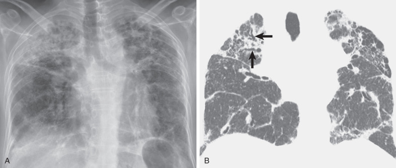 Fig. 5.21, Pulmonary fibrosis in sarcoidosis. (A) Chest radiograph shows extensive bilateral reticulonodular pattern involving mainly the upper lobes with associated volume loss. (B) Coronal reformation CT scan shows upper lobe distribution of the reticulation and traction bronchiectasis (arrows). Note superior retraction of the hila and compensatory overinflation of the lower lobes. Small perilymphatic nodules in the upper and middle lung zones typical of sarcoidosis also are evident.