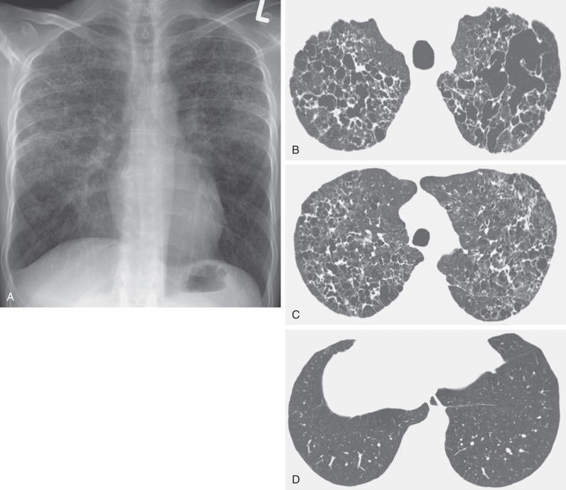 Fig. 5.22, Pulmonary Langerhans cell histiocytosis. (A) Chest radiograph shows diffuse reticular pattern in the upper and middle lung zones, with sparing of the lower lung zones. (B) High-resolution CT scan at the level of the lung apices shows numerous bilateral thin-walled cysts. Conglomeration of cysts in the left upper lobe has led to the formation of large cysts with bizarre shapes. (C) High-resolution CT scan slightly above the level of the aortic arch shows numerous bilateral cysts, a few small nodules, and ground-glass opacities. (D) High-resolution CT scan at the level of the lung bases shows minimal abnormalities. The patient was a smoker and developed pulmonary Langerhans cell histiocytosis. The ground-glass opacities reflect the presence of respiratory bronchiolitis (“smoker's bronchiolitis”).