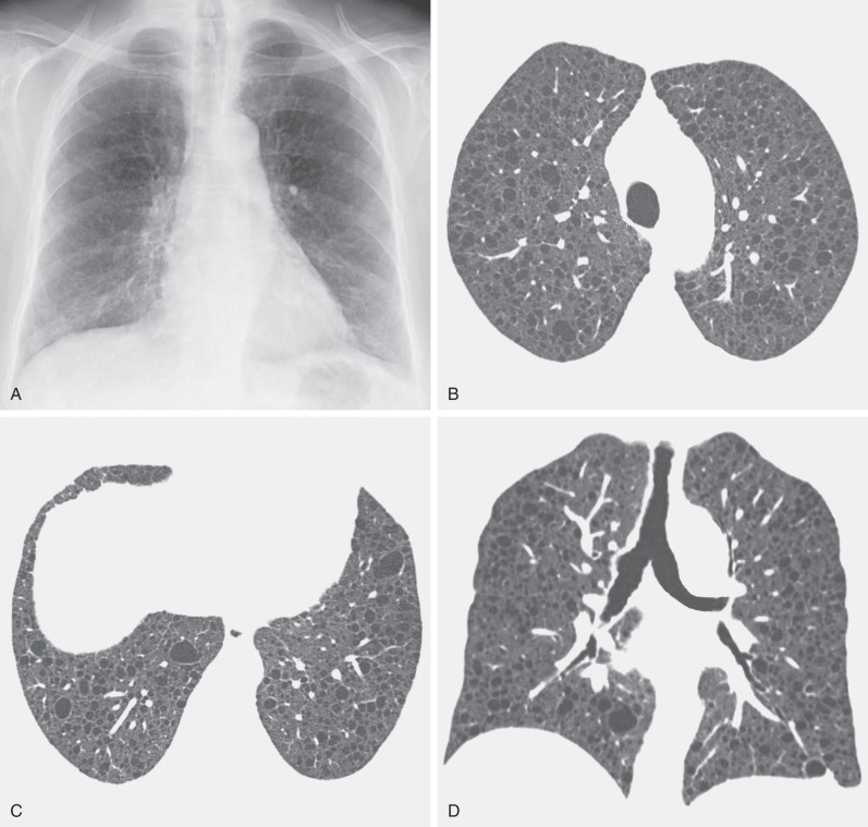 Fig. 5.23, Lymphangioleiomyomatosis. (A) Posteroanterior chest radiograph shows diffuse fine reticular pattern with distortion of the pulmonary vasculature and small areas of lucency. (B) High-resolution CT scan at the level of the upper lobes shows numerous bilateral thin-walled cysts. (C) High-resolution CT scan at the level of the lung bases shows diffuse involvement similar to that in the upper lobes. (D) Coronal reformation shows diffuse distribution of cysts and large lung volumes.