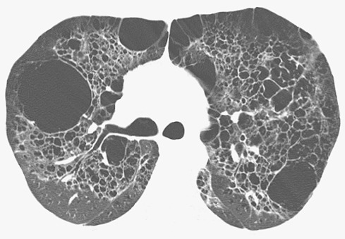 Fig. 5.24, Pneumocystis pneumonia in a patient with AIDS. High-resolution CT scan at the level of the upper lobes shows numerous bilateral cysts of various sizes and evidence of paraseptal and centrilobular emphysema. Ground-glass opacities adjacent to the cystic spaces also are noted.