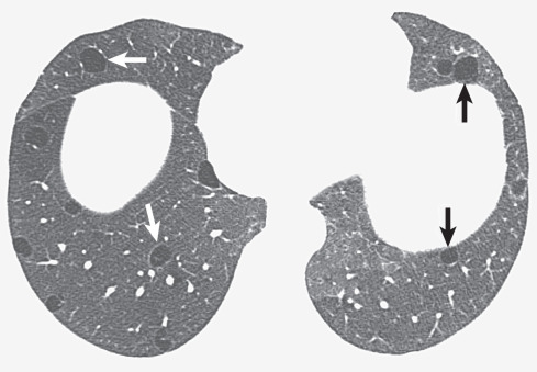 Fig. 5.25, Lymphoid interstitial pneumonia in a lifelong nonsmoker. High-resolution CT scan shows patchy bilateral ground-glass opacities and several thin-walled cysts (arrows).