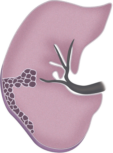 Fig. 5.26, Schematic drawing of the right lung illustrates honeycombing. Honeycombing is characterized on high-resolution CT scan by the presence of clustered cystic airspaces with well-defined walls and typically measuring 3–10 mm in diameter. Honeycombing is a CT feature of end-stage pulmonary fibrosis.