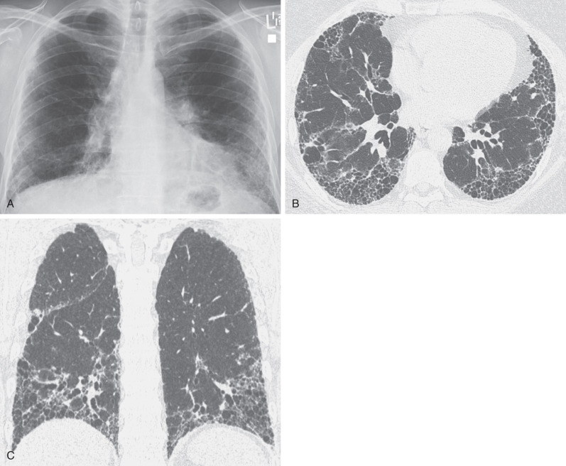 Fig. 5.27, Honeycombing in end-stage idiopathic pulmonary fibrosis. (A) Posteroanterior chest radiograph shows bilateral reticular pattern mainly in the peripheral lung and lower lung zones. (B) High-resolution CT scan shows extensive subpleural honeycombing. (C) Coronal reformation image shows peripheral and basal distribution of the honeycomb cysts.