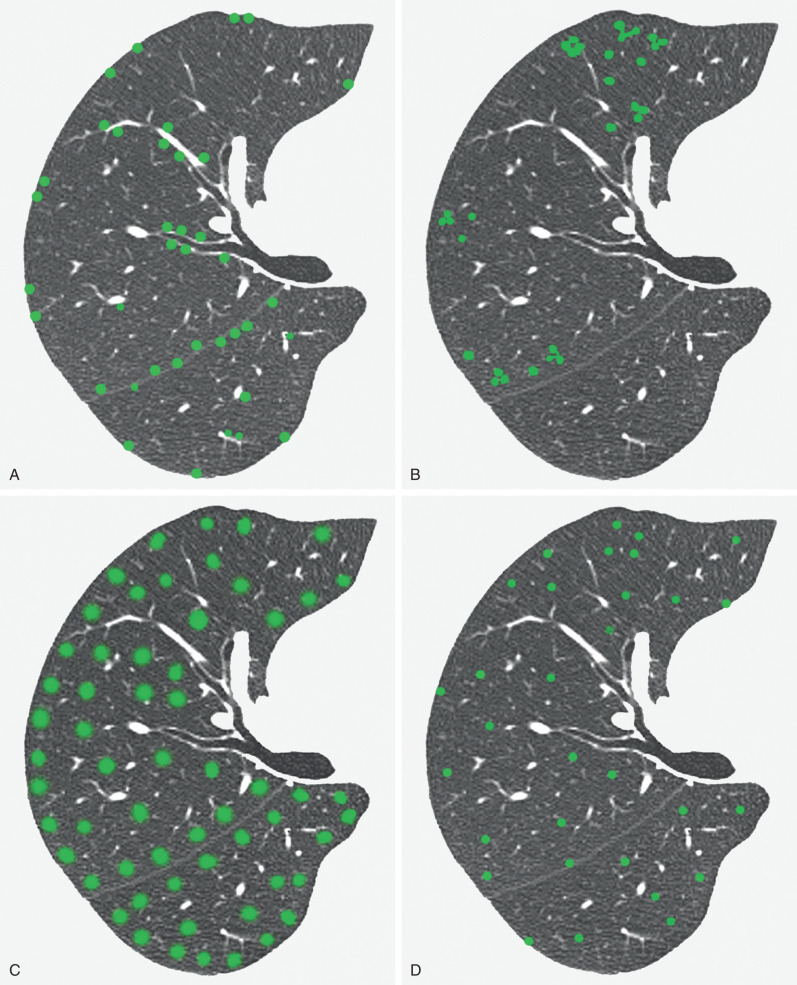 Fig. 5.29, Schematic drawing of nodular pattern and distribution. (A) Perilymphatic distribution is characterized by the presence of nodules along the bronchovascular interstitium, interlobular septa, and subpleural lung regions. (B) and (C) Centrilobular distribution is characterized by the presence of nodules a few millimeters away from the interlobular septa, visceral pleura, interlobar fissures, large vessels, and bronchi. Centrilobular nodules that are well defined with a tree-in-bud appearance and in a patchy distribution (B) are seen most commonly in infectious bronchiolitis. Poorly defined centrilobular nodular opacities (C) are seen most commonly in bronchiolocentric alveolitis as occurs in hypersensitivity pneumonitis and respiratory bronchiolitis. (D) Random distribution is characterized by nodules located throughout the secondary pulmonary lobule without any particular predominance. Some nodules may appear to be centrilobular, whereas others may appear to be perilymphatic.