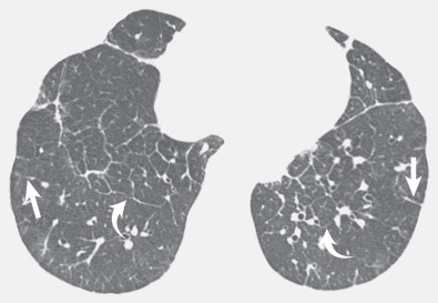 Fig. 5.4, Smooth septal thickening in a patient with interstitial pulmonary edema from left heart failure. High-resolution CT scan at the level of the lower lung zones shows smooth septal lines perpendicular to the pleura (straight arrows) and more centrally as polygonal arcades (curved arrows).