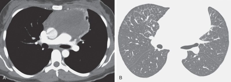 Fig. 5.5, Septal thickening in non-Hodgkin lymphoma. (A) Contrast-enhanced CT scan shows large anterior (prevascular) mediastinal mass. (B) Lung windows show bilateral thickening of the interlobular septa.