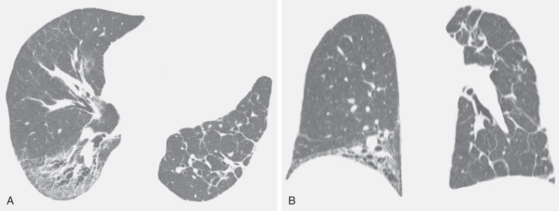 Fig. 5.6, Smooth septal thickening in acute lung rejection. (A) High-resolution CT scan performed in a 41-year-old man with unilateral left lung transplant shows thickening of several interlobular septa in the transplanted lung. Interstitial fibrosis, which was proven to be nonspecific interstitial pneumonia, is evident in the native right lung. (B) Coronal reformation shows extensive septal thickening in the transplanted left lung and lower lung zone fibrosis in the native right lung. Transbronchial biopsy specimens of the left lung showed acute rejection.