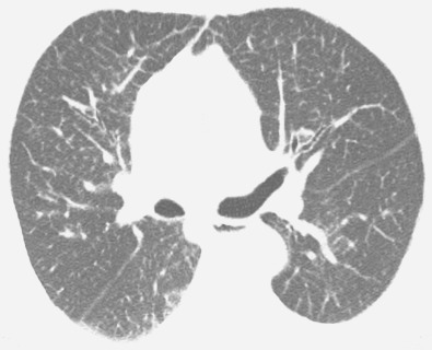 Fig. 5.7, Septal thickening in Niemann-Pick disease. High-resolution CT scan at the level of the bronchus intermedius shows mild bilateral interlobular septal thickening.