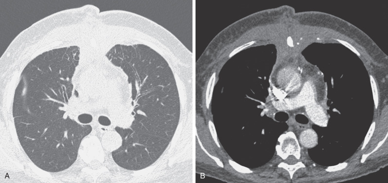 Fig. 5.8, Septal thickening as a result of pleural inflammation in the setting of sternal osteomyelitis after coronary artery bypass graft surgery. (A) High-resolution CT scan shows interlobular septal thickening in the anterior region of the upper lobes. (B) Contrast-enhanced CT scan shows increased soft tissue in the parasternal region and bilateral chest wall and mediastinal pleural thickening. Sternal wound culture grew methicillin-resistant Staphylococcus aureus.