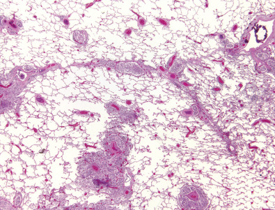 Fig. 5.9, Septal thickening as a result of lymphangitic carcinomatosis. Histologic specimen shows nodular thickening of the interlobular septa by tumor cells.