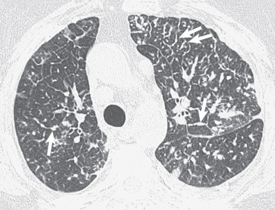 Fig. 5.10, Nodular septal thickening in lymphangitic carcinomatosis. High-resolution CT scan shows extensive bilateral septal thickening and small left pleural effusion. Several of the thickened septa have a beaded nodular appearance (arrows). Also evident are enlarged mediastinal lymph nodes.