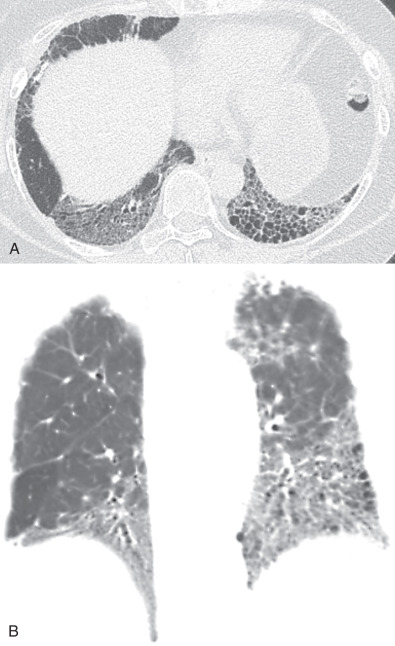 Fig. 45.1, A 60-year-old woman with interstitial pneumonia with autoimmune features and a fibrotic nonspecific interstitial pneumonia (NSIP) pattern. Supine axial (A) and coronal (B) high-resolution computed tomography images demonstrate basilar predominant peribronchovascular ground-glass opacities and traction bronchiectasis with some superimposed honeycombing. Findings are most compatible with a fibrotic NSIP pattern.