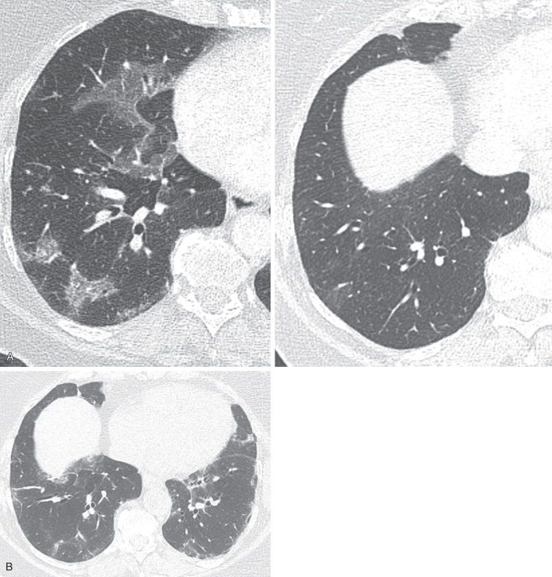 Fig. 45.2, A 67-year-old woman with interstitial pneumonia with autoimmune features and organizing pneumonia (OP). (A) Composite image with axial high-resolution computed tomography (HRCT) image (left image) demonstrates basilar predominant peripheral and peribronchovascular predominant ground-glass opacities typical of OP, which resolve with immunosuppressive therapy (right image). (B) Axial HRCT image obtained one additional year later demonstrates increased basilar predominant ground-glass opacities with traction bronchiectasis. Some of the opacities demonstrate a perilobular distribution, a finding often seen in OP.