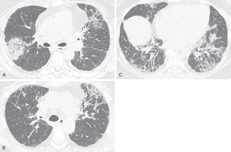 Fig. 45.3, A 56-year-old woman with interstitial pneumonia with autoimmune features (IPAF) and organizing pneumonia (OP) progressing to fibrotic nonspecific interstitial pneumonia (NSIP). (A) Axial high-resolution computed tomography (HRCT) image demonstrates peripheral and peribronchovascular consolidation with central ground-glass opacities (reverse halo configuration), most compatible with OP. A small left pleural effusion is noted, which is a common finding of multi-compartmental involvement in patients with IPAF. (B) and (C) Axial HRCT images obtained one year later demonstrate resolution of the peripheral consolidation and ground-glass opacities with progression of basilar, peripheral, and peribronchovascular predominant ground-glass opacities and traction bronchiectasis most suggestive of fibrotic NSIP.