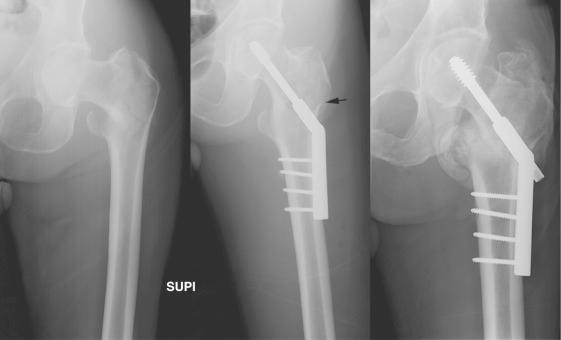 Fig. 44.2, Serial anteroposterior radiographs of a patient showing progressive collapse of a compression hip screw comparing the immediate postoperative image (middle panel) with another image 5 months later (right panel). The arrow in the middle panel shows loss of integrity of the lateral wall of the greater trochanter, which is associated with excessive collapse when sliding hip screws are used.