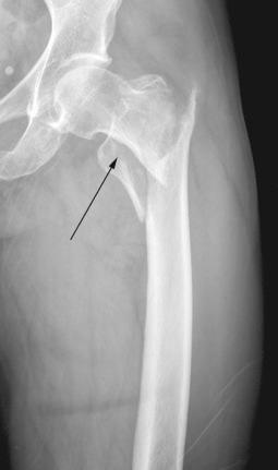 Fig. 44.3, Example of an intertrochanteric femur fracture with a large posteromedial fragment (arrow).