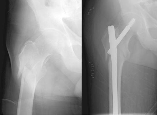 Fig. 44.4, Preoperative (left panel) and postoperative (right panel) anteroposterior radiographs of a reverse-obliquity fracture of the proximal femur, reduced and stabilized with a cephalomedullary nail.