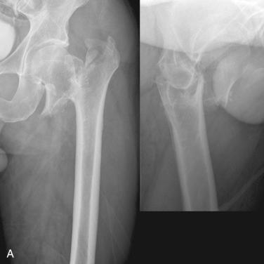 Fig. 44.6, Example of an intertrochanteric fracture of the femur treated with a cephalomedullary nail. (A) Preoperative anteroposterior and lateral radiographs. (B) Postoperative radiographs following reduction and cephalomedullary nailing.