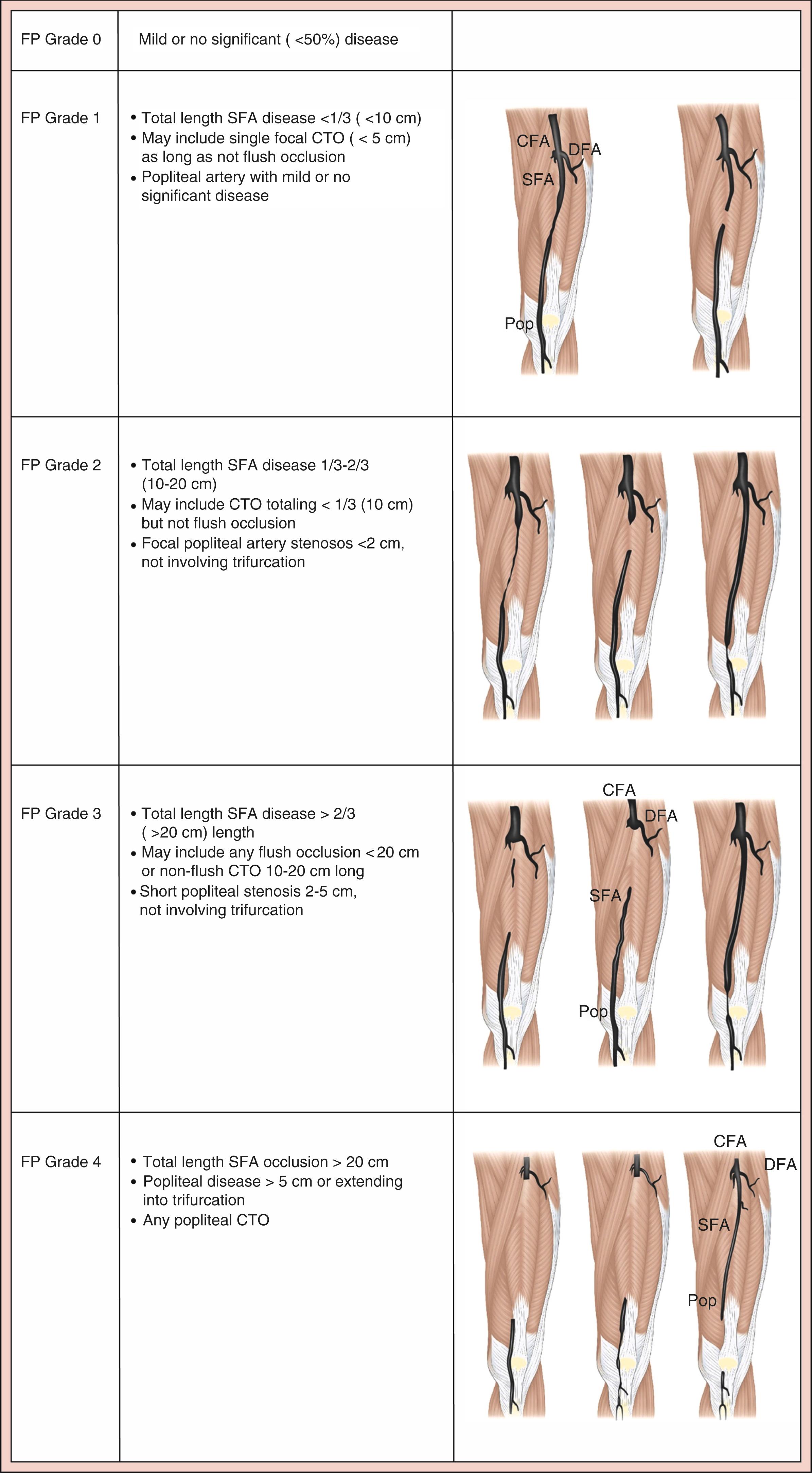 Figure 4.2, Femoropopliteal (FP) disease grading in Global Limb Anatomic Staging System (GLASS). Trifurcation is defined as the termination of the popliteal artery at the confluence of the anterior tibial (AT) artery and tibioperoneal trunk. CFA , Common femoral artery; CTO , chronic total occlusion; DFA , deep femoral artery; Pop , popliteal; SFA , superficial femoral artery.