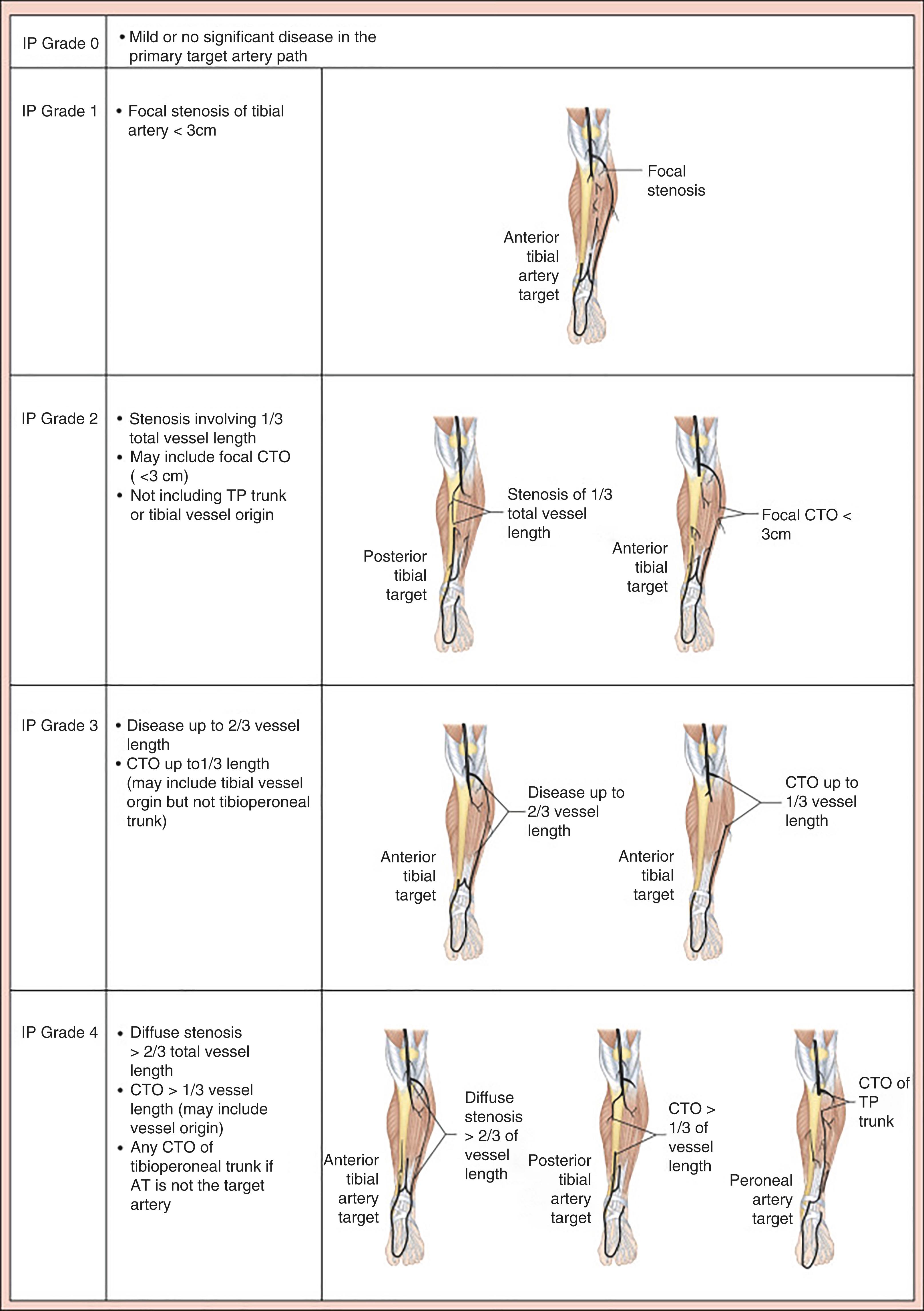 Figure 4.3, Infrapopliteal (IP) disease in Global Limb Anatomic Staging System (GLASS). AT , Anterior tibial; CTO , chronic total occlusion; TP , tibioperoneal.