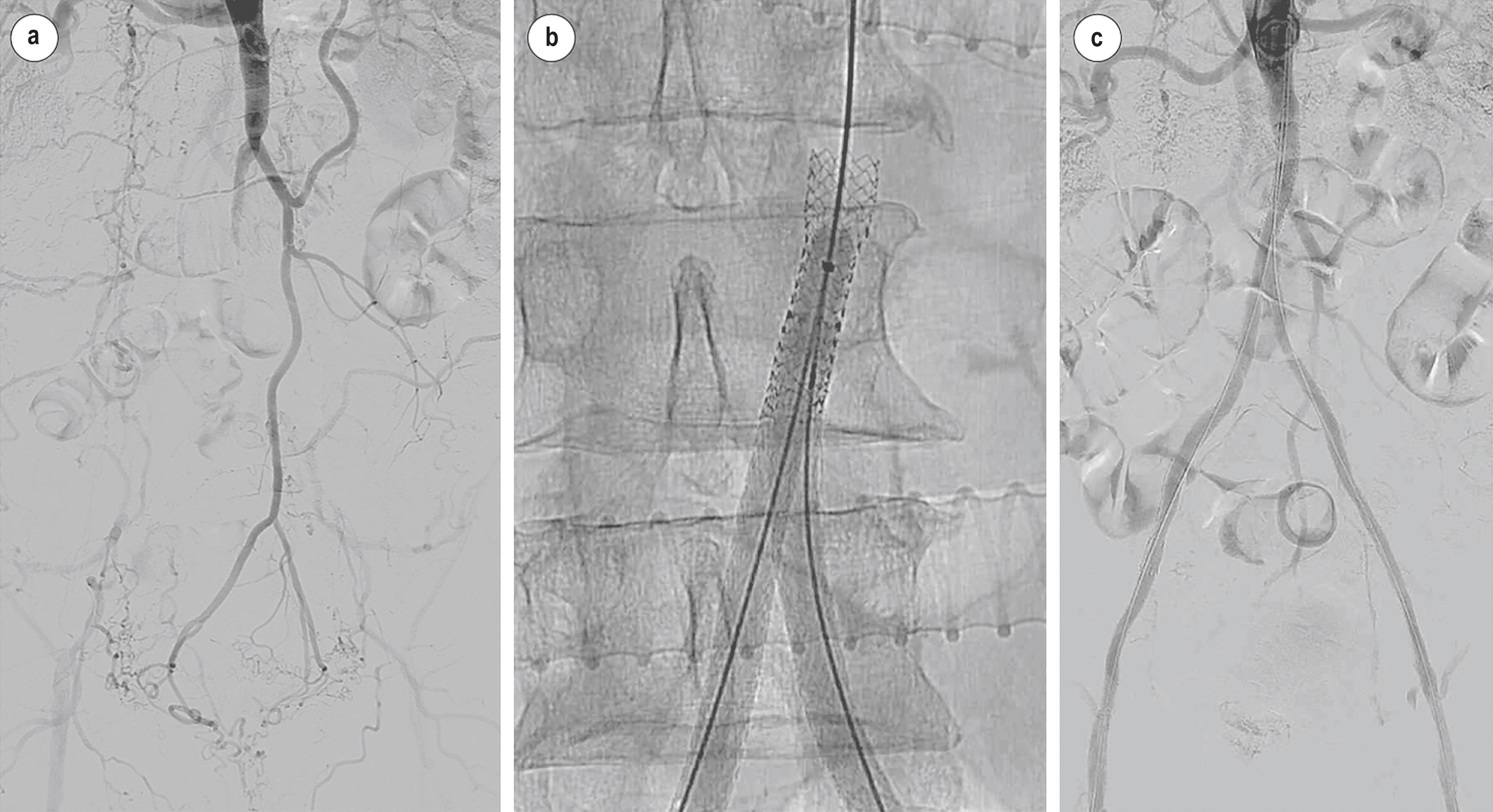 Figure 4.4, (a) Complete occlusion of the aorta (distal to the inferior mesenteric artery), common and external iliac arteries. (b) Post-dilatation after implantation of two self-expanding iliac stents within a single large balloon-expandable stent for the aorta. (c) Completion subtraction angiogram demonstrating unimpeded flow and complete revascularisation.