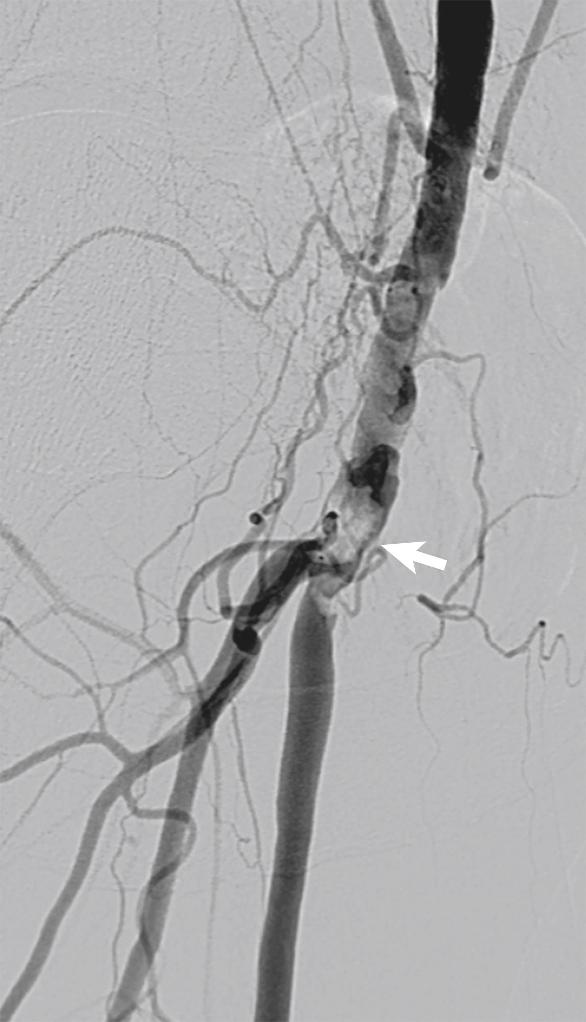 Figure 4.5, Typically, atherosclerotic disease found in the common femoral artery is calcified and eccentric ( arrow ). It frequently involves the origins of both superficial femoral and profunda femoris arteries, making femoral endarterectomy preferable to percutaneous transluminal angioplasty and stent implantation.