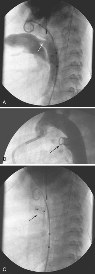 FIGURE 22.4, A, Lateral angiography demonstrates a patent ductus arteriosus (PDA) ( arrow ). The PDA lies between aorta and pulmonary artery ( arrow ). The angiography catheter is in the proximal aorta. B, Lateral angiography after closure of the PDA with a coil ( arrow ). C, Lateral fluoroscopy after closure of the PDA with the Amplatzer TM Duct Occluder device. The device ( arrow ) is in the PDA.