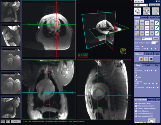 FIG. 47.3, Screenshot of a commercial interventional cardiovascular magnetic resonance (iCMR) user interface. The iCMR interface is designed to accommodate interleaved multislice real-time CMR image acquisition (three panels on left), a volume rendering of the slices indicating their three-dimensional relationship (center panel), “postage stamps” to store and recall important graphical slice prescriptions (bottom row), and interactive scanner parameter control (right panels).