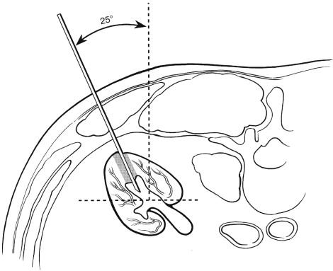 FIGURE 10-7, Diagram depicting ideal transrenal puncture location. Puncture of a posterior calyx from a 25-degree angle should traverse the zone of relative avascularity and avoid large renal artery branches.