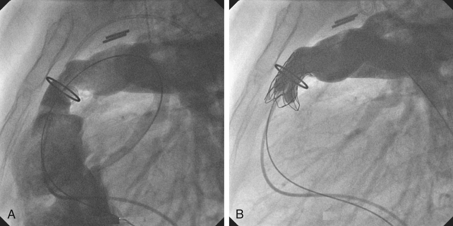 Fig. 18.3, Transcatheter pulmonary valve replacement. (A) Lateral projection of a pulmonary angiogram showing free pulmonary regurgitation through a Hancock conduit. (B) Insertion of a Melody valve has resolved the problem. (C) Frontal projection of a patient with tetralogy of Fallot following transannular patch repair with free pulmonary regurgitation. (D) Transcatheter placement of a Sapien valve within the patched right ventricular outflow tract has resolved this problem.